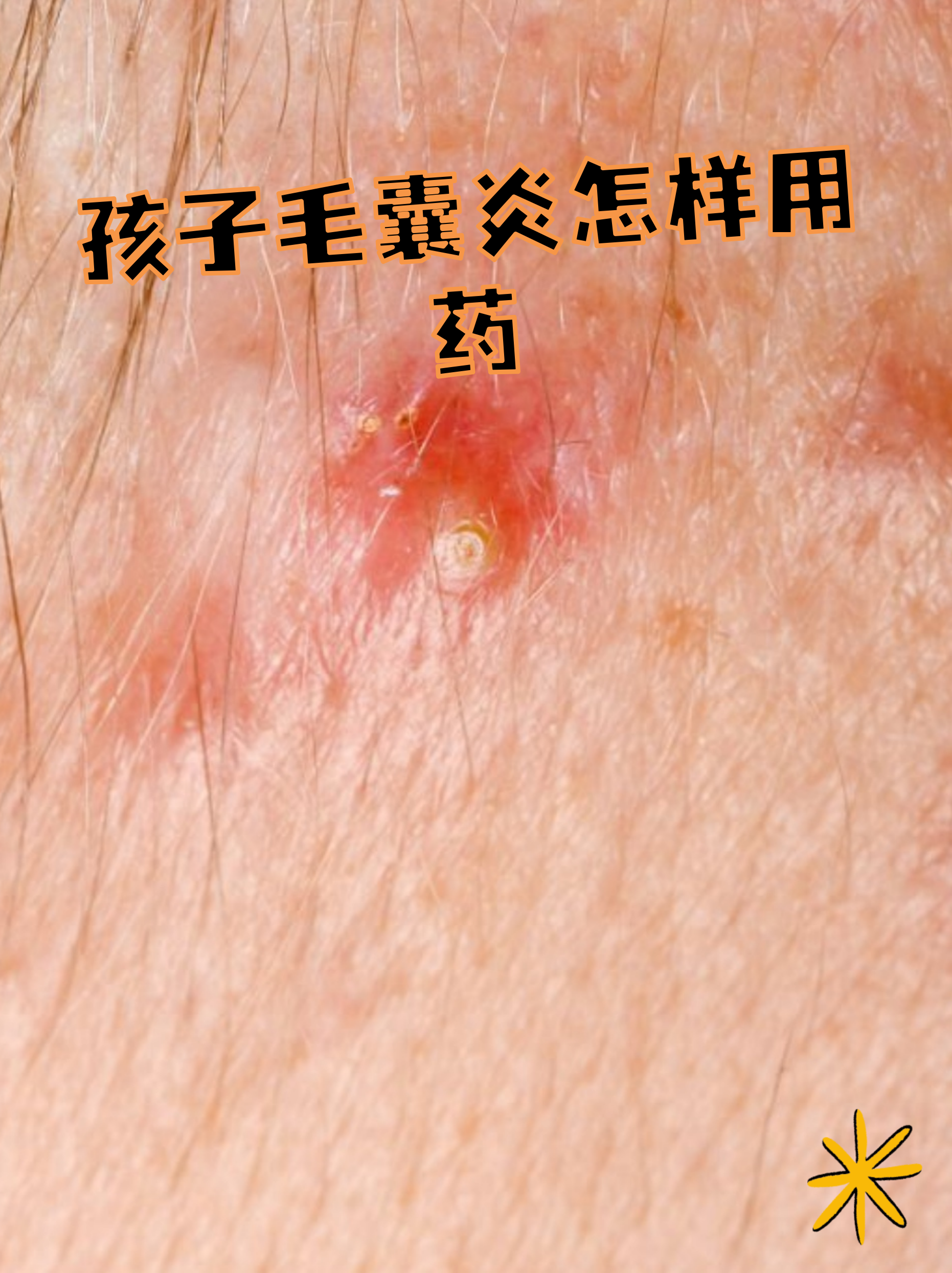 孩子毛囊炎是常见的皮肤问题,表现为红肿,疼痛的