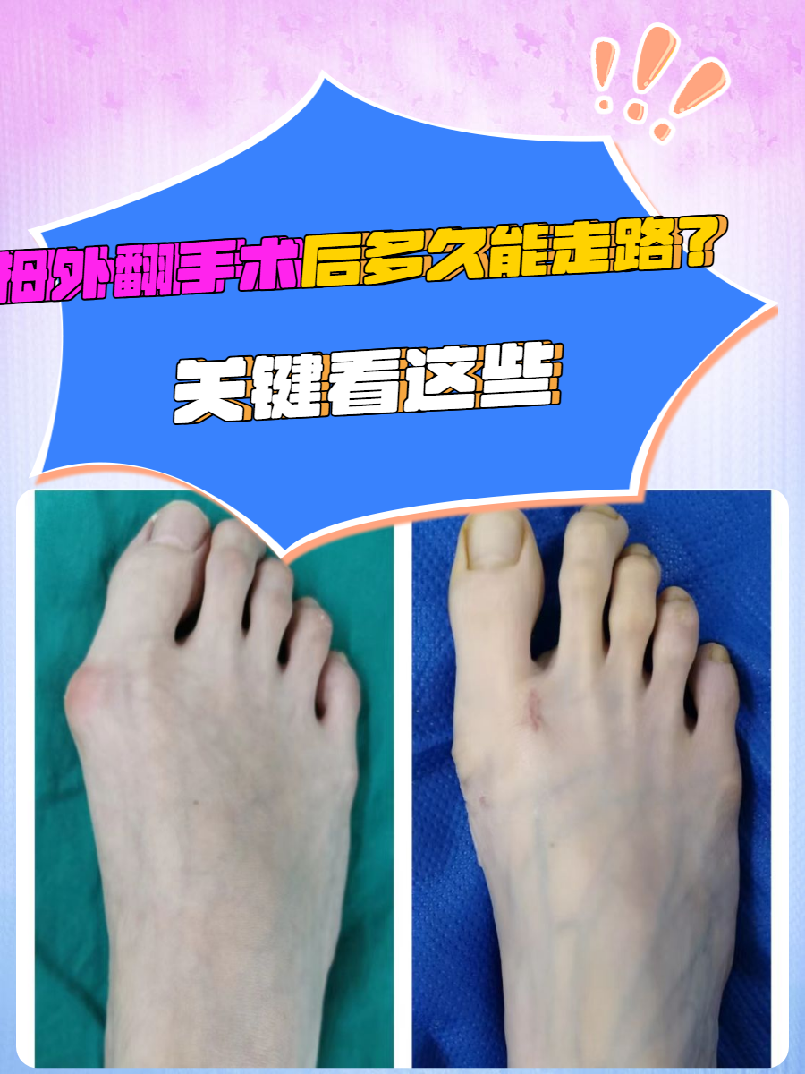 看着变形的大脚趾,走路疼痛难忍,终于下定决心做拇外翻