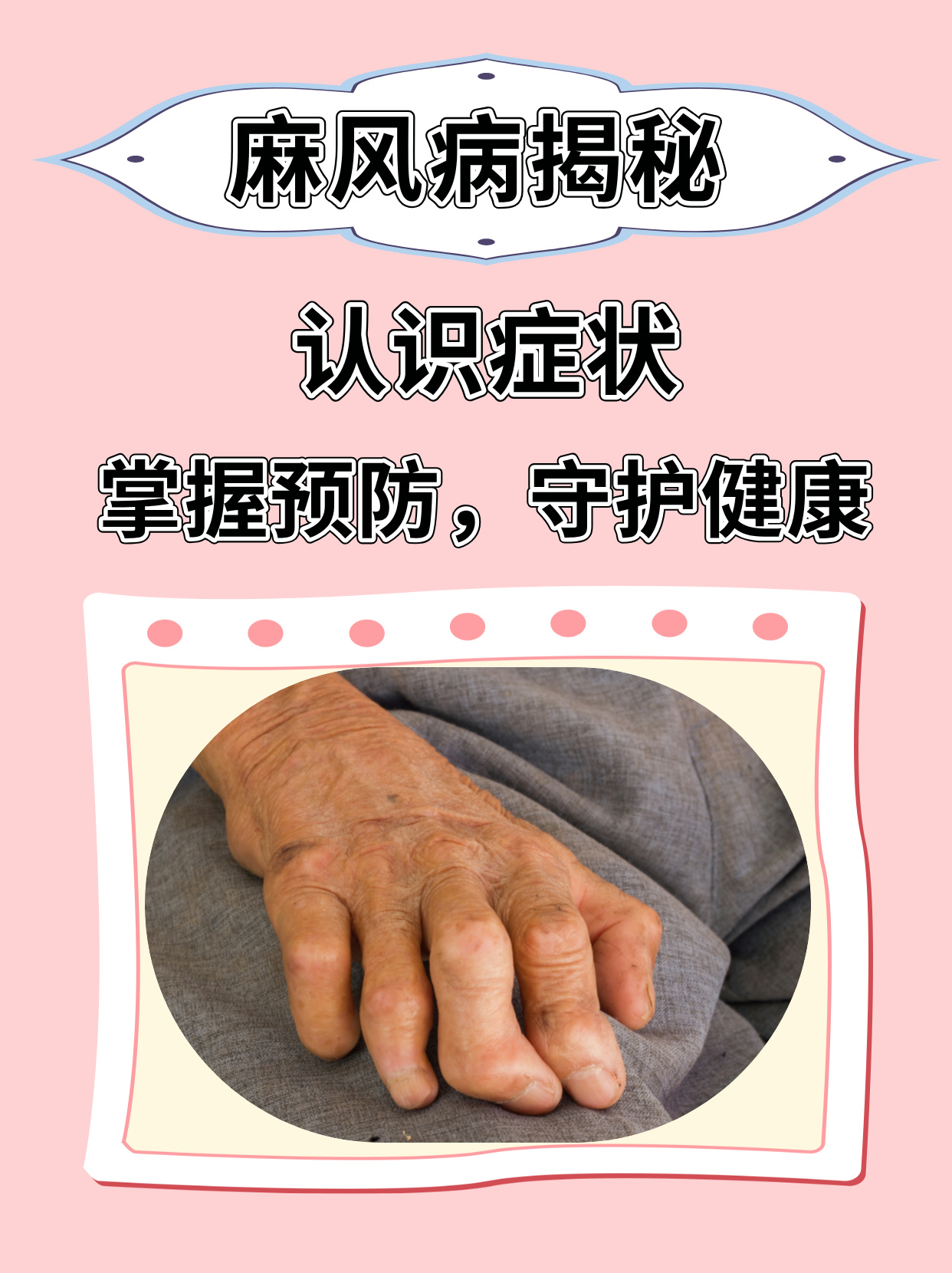 麻风病,也被称为汉森氏病,是一种由麻风分枝杆菌引起的慢性传染性