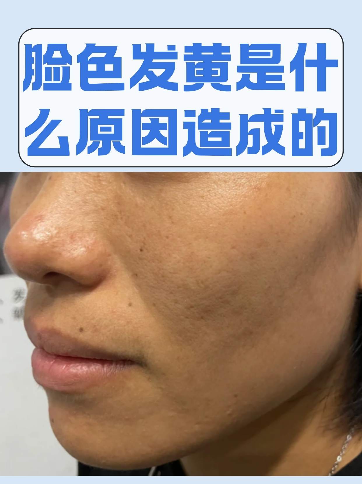 脸色发黄是什么原因造成的  脸色发黄是许多人都可能遇到的问题,它
