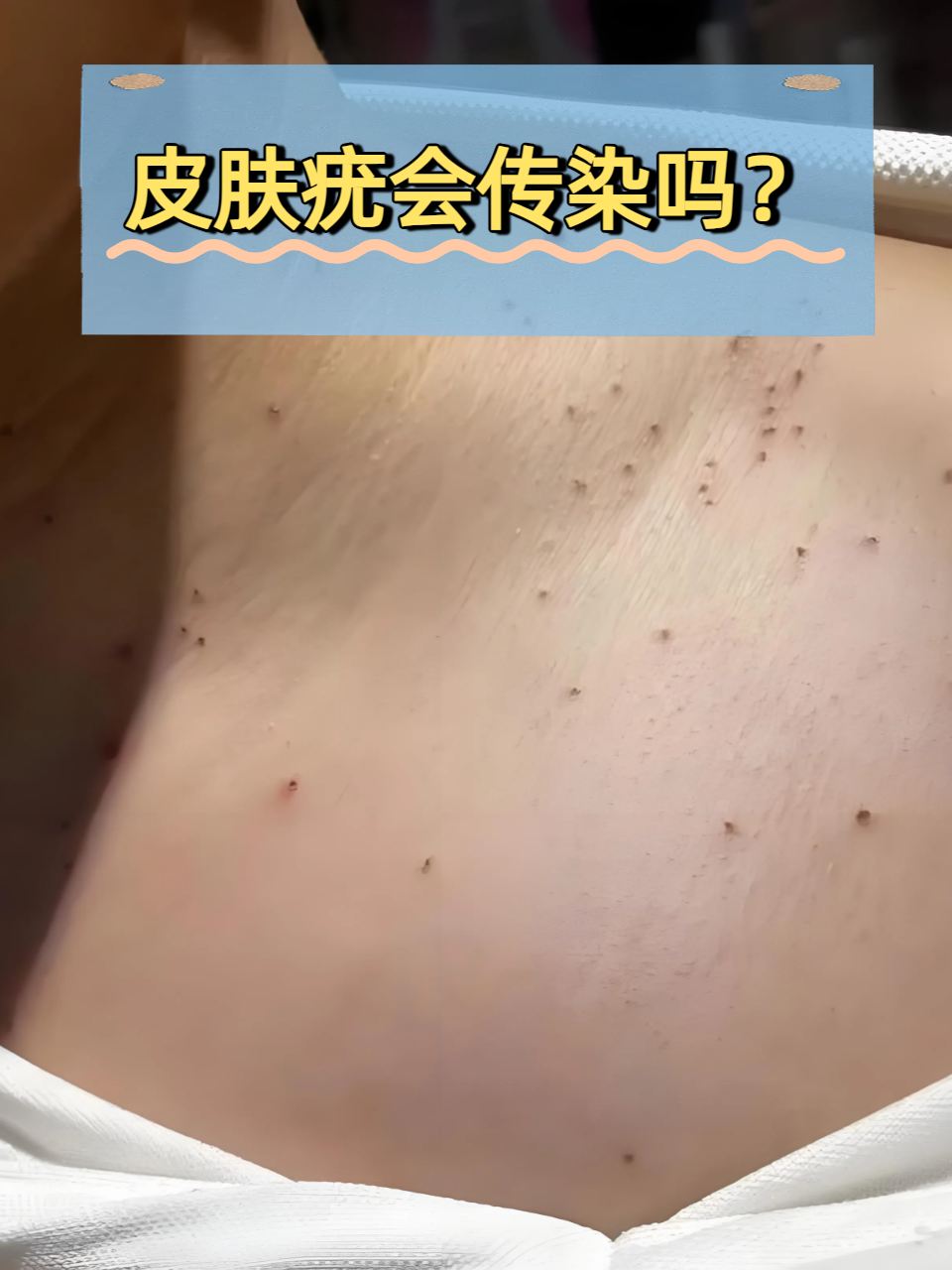 皮肤为什么会长疣