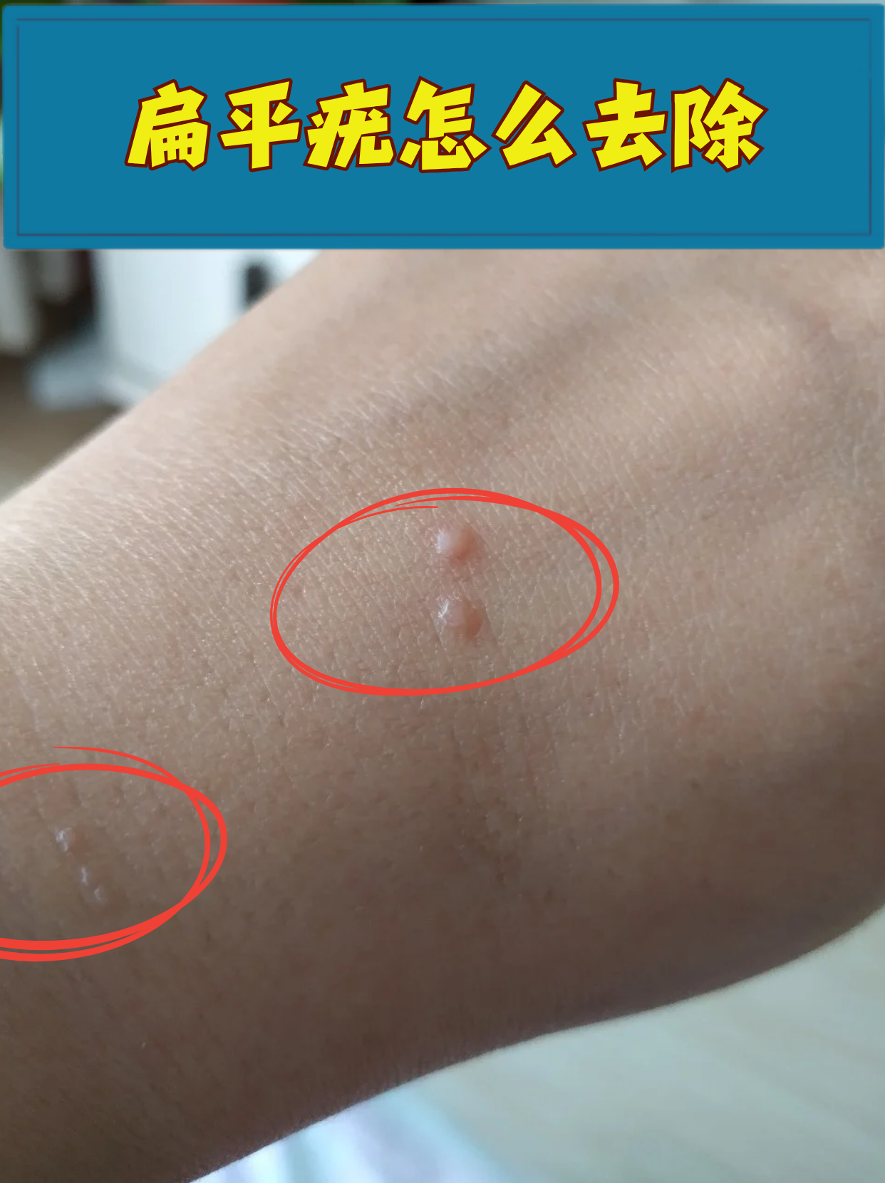 扁平疣虽然不痛不痒,但影响美观还可能传染,今天教你科学应对方法