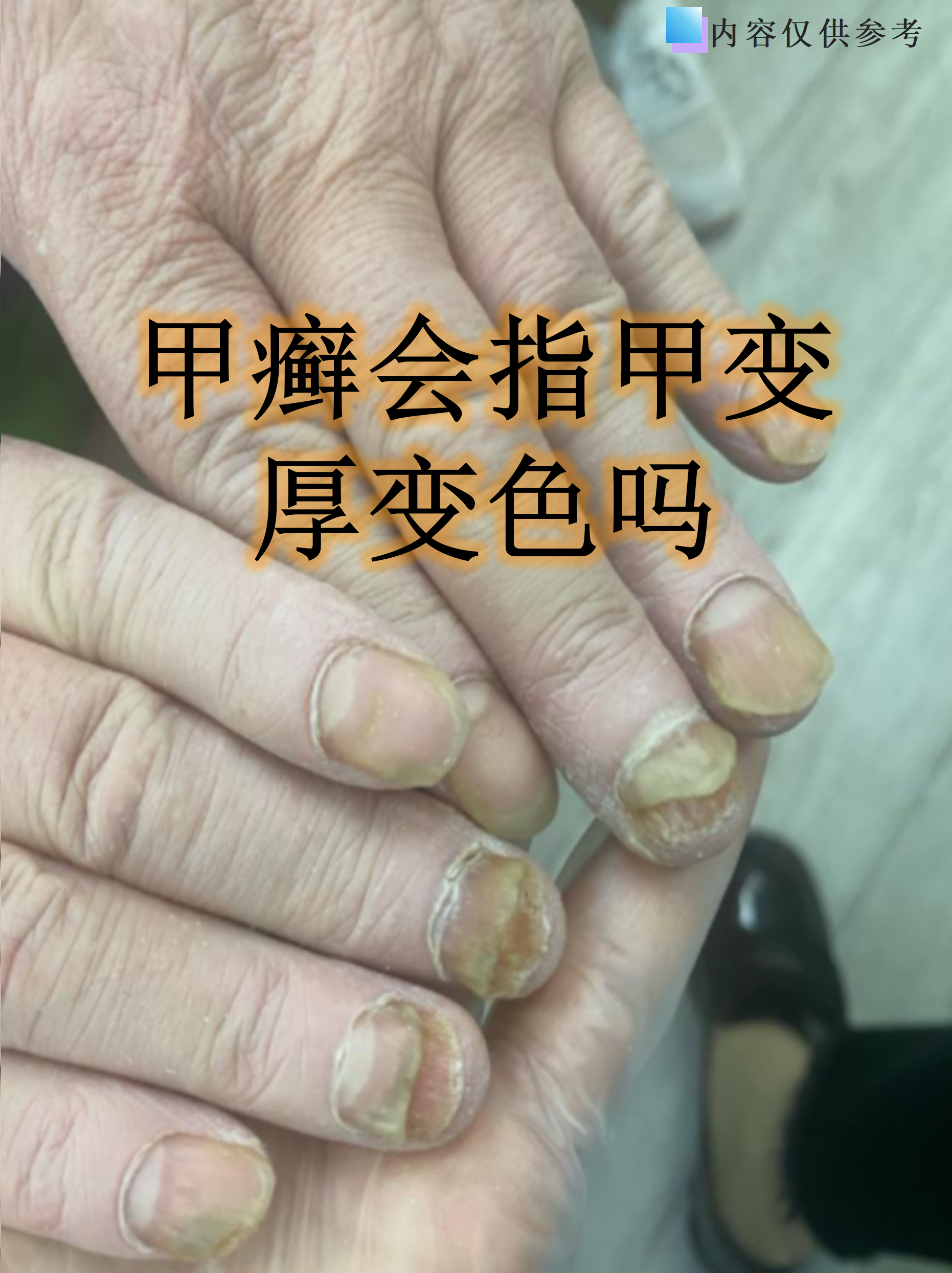 这种由真菌感染引发的指甲问题,早期干预能有效避免传染和加重