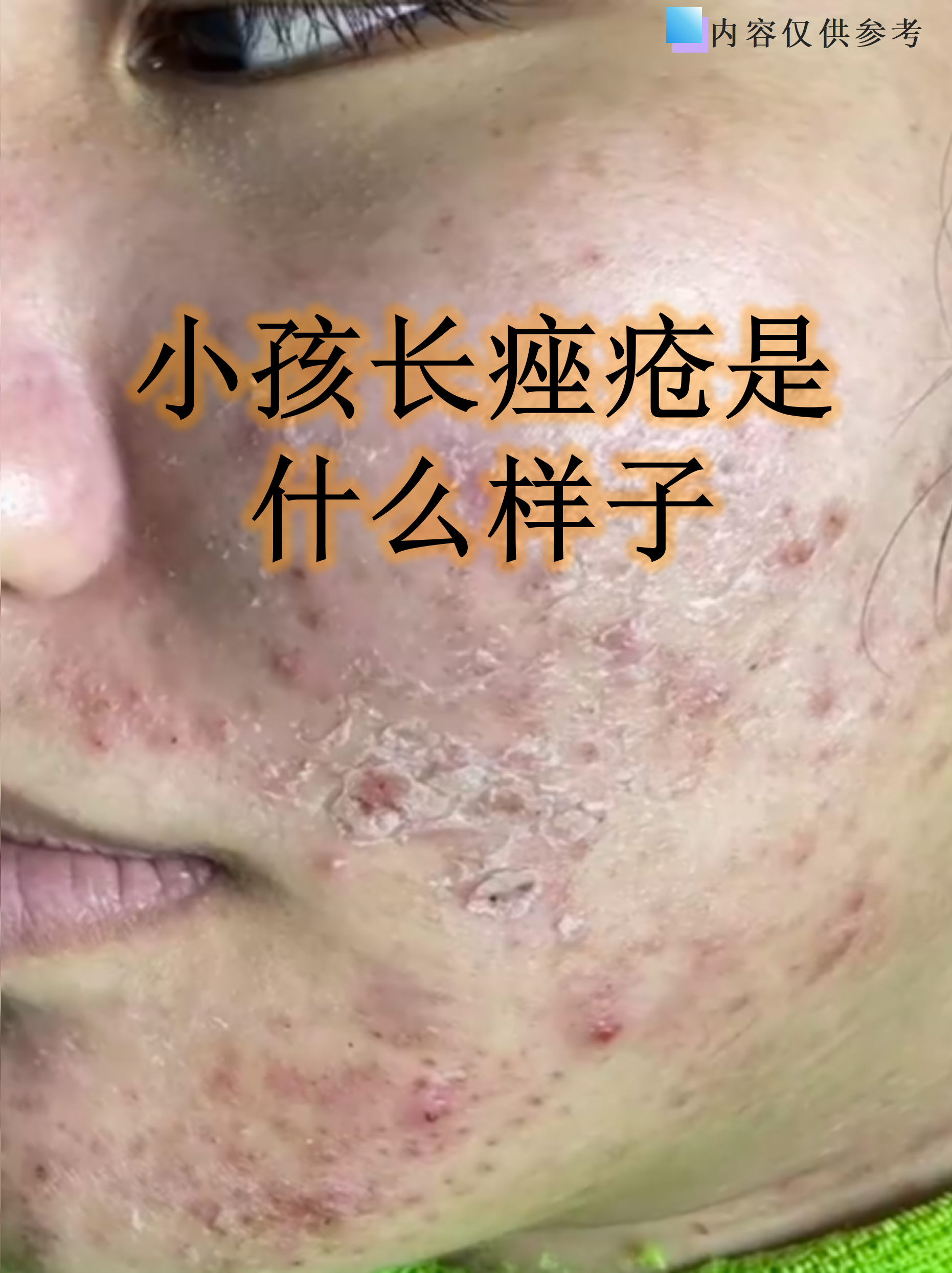 其实痤疮在儿童中并不少见,尤其是青春期前的孩子,可能与激素变化