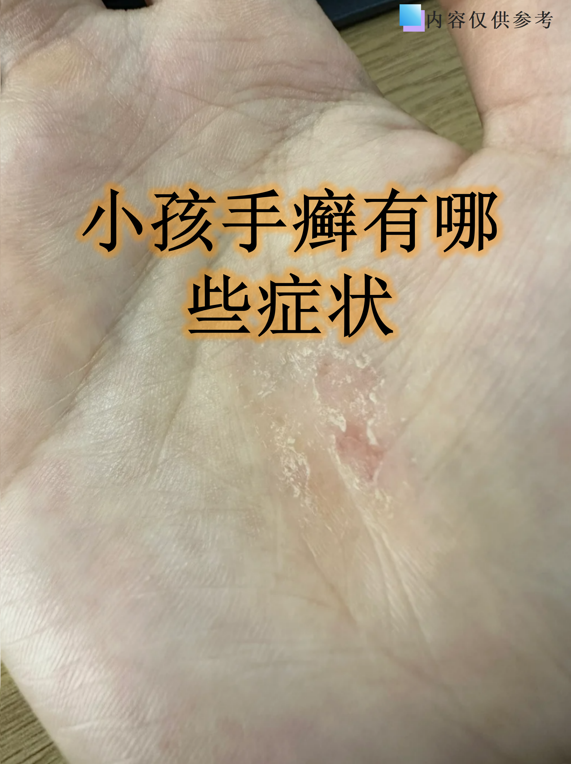孩子手上出现红斑脱皮?当心可能是手癣在作怪