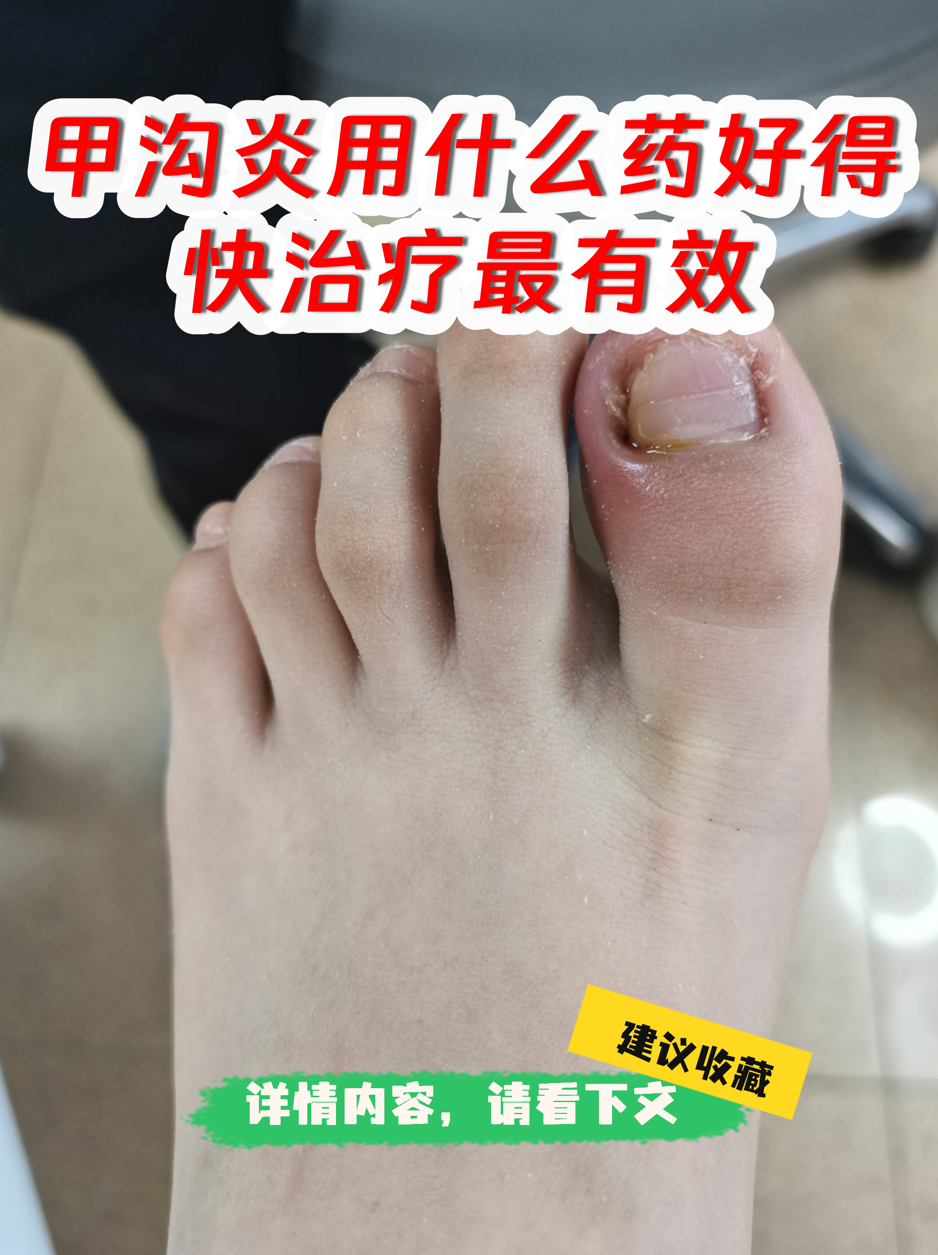 甲沟炎常用药物 抗感染药:轻中度感染可外用抗生素软膏,如莫匹罗