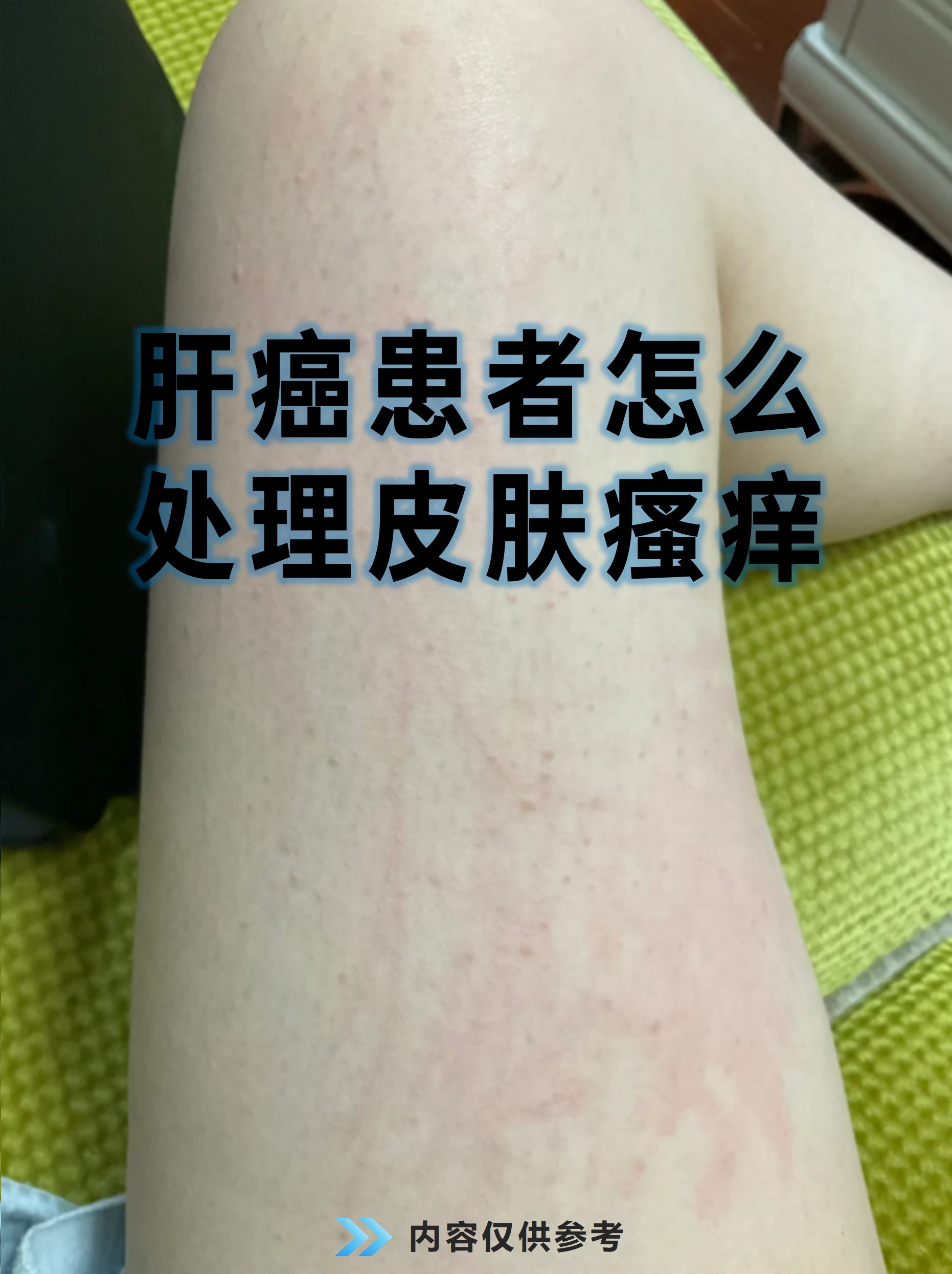 肝癌患者出现皮肤瘙痒可能与肝功能异常,胆红素升高或药物副作用庸刎