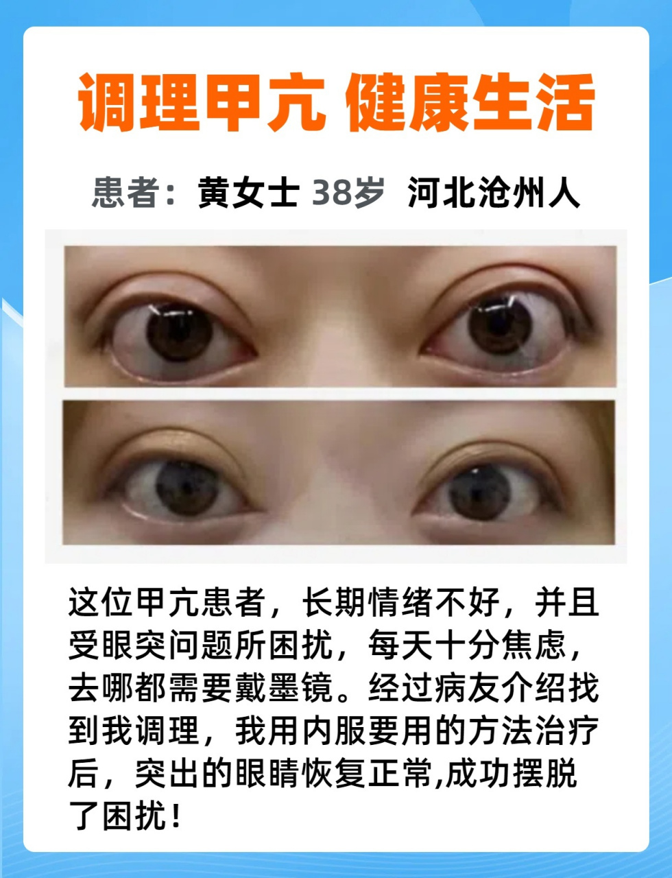 经过病友介绍找到我调理,我用内服要用的方法治疗后,突出的眼睛恢复