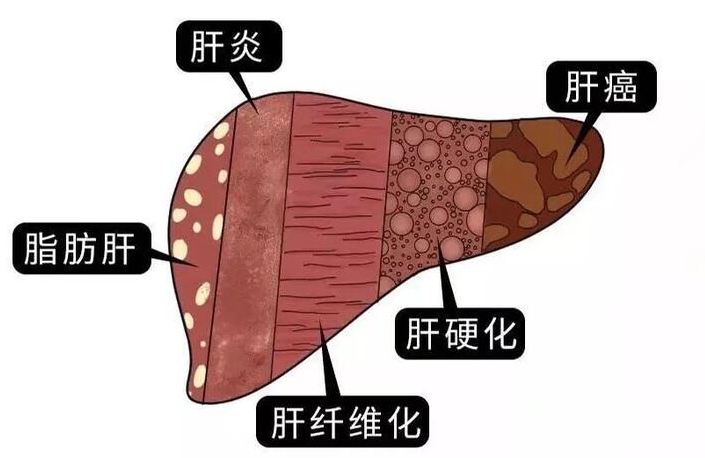 肝病患者注意忌口,这3样食物最好别沾,避免加重肝病!