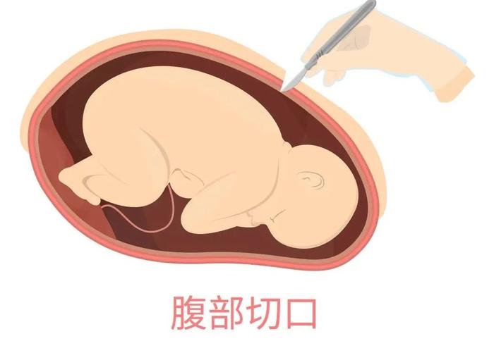 一般4-6周愈合,不管腹部伤口还是子宫伤口完全恢复至少要3个月左右