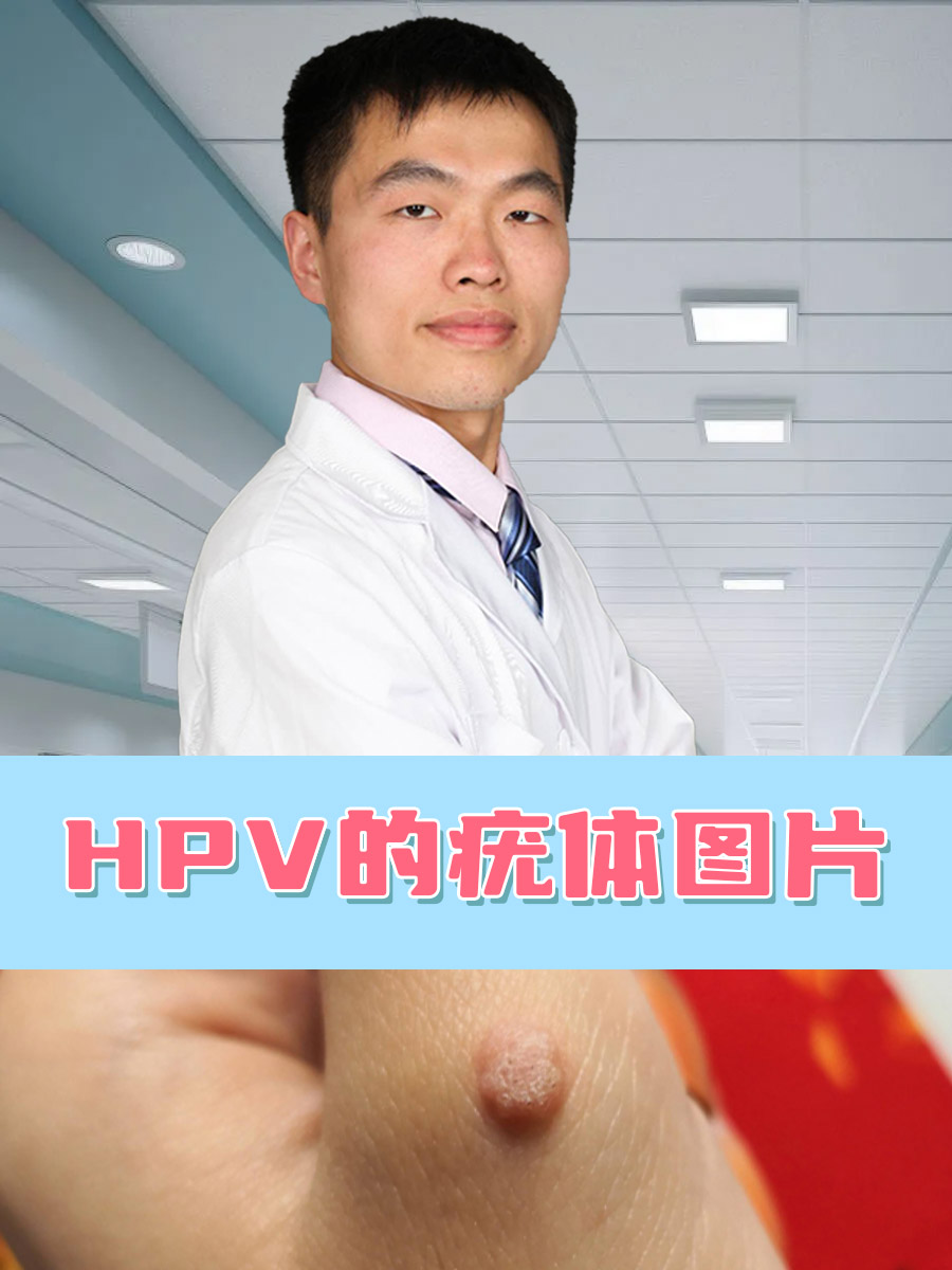 女性hpv照片 尖锐湿图片