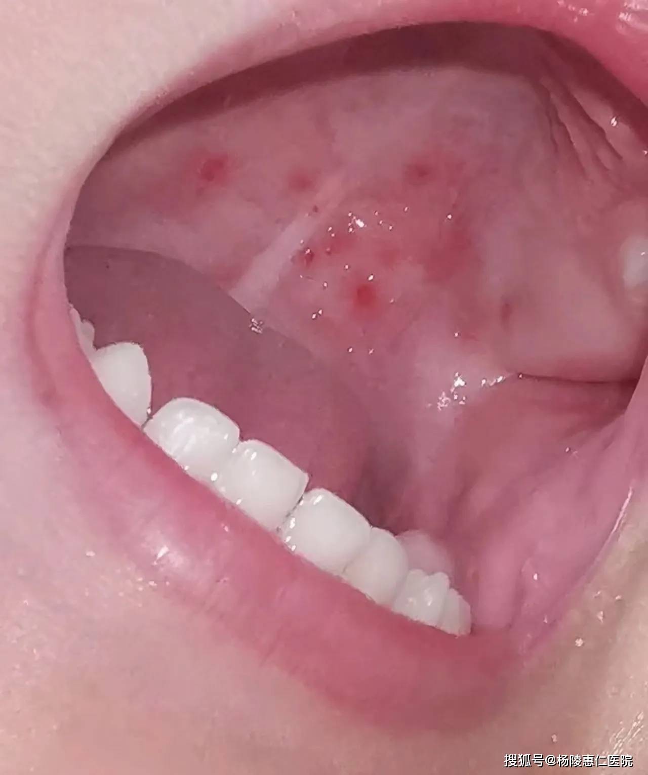 艾滋病患者常见的口腔黏膜表现