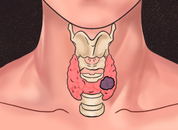 甲状腺结节位置图高清图片