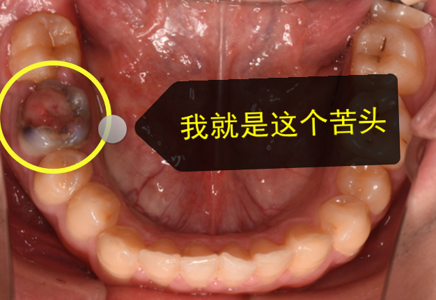 牙龈息肉治疗图片