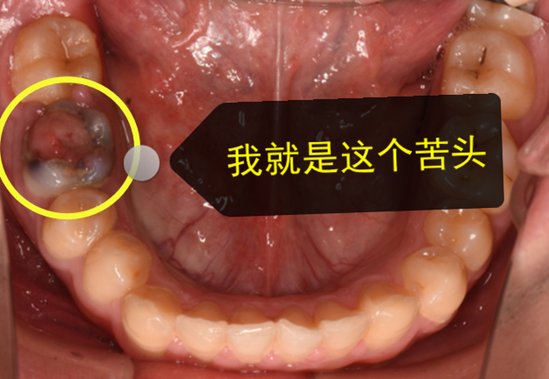 牙齿表面长了个牙刺图片