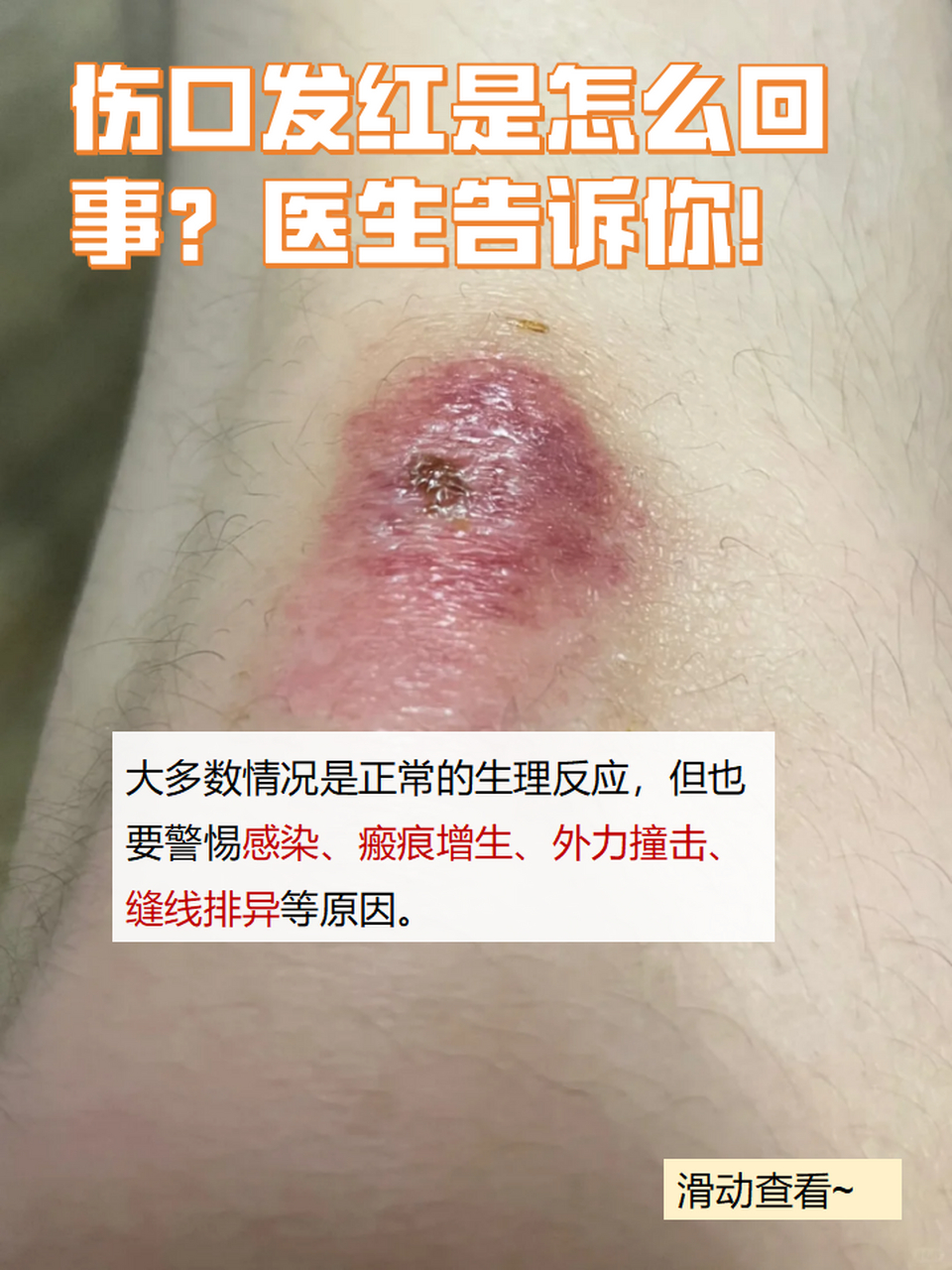 94伤口发红,是我们日常生活中经常遇到的情况,但大家知道这背后