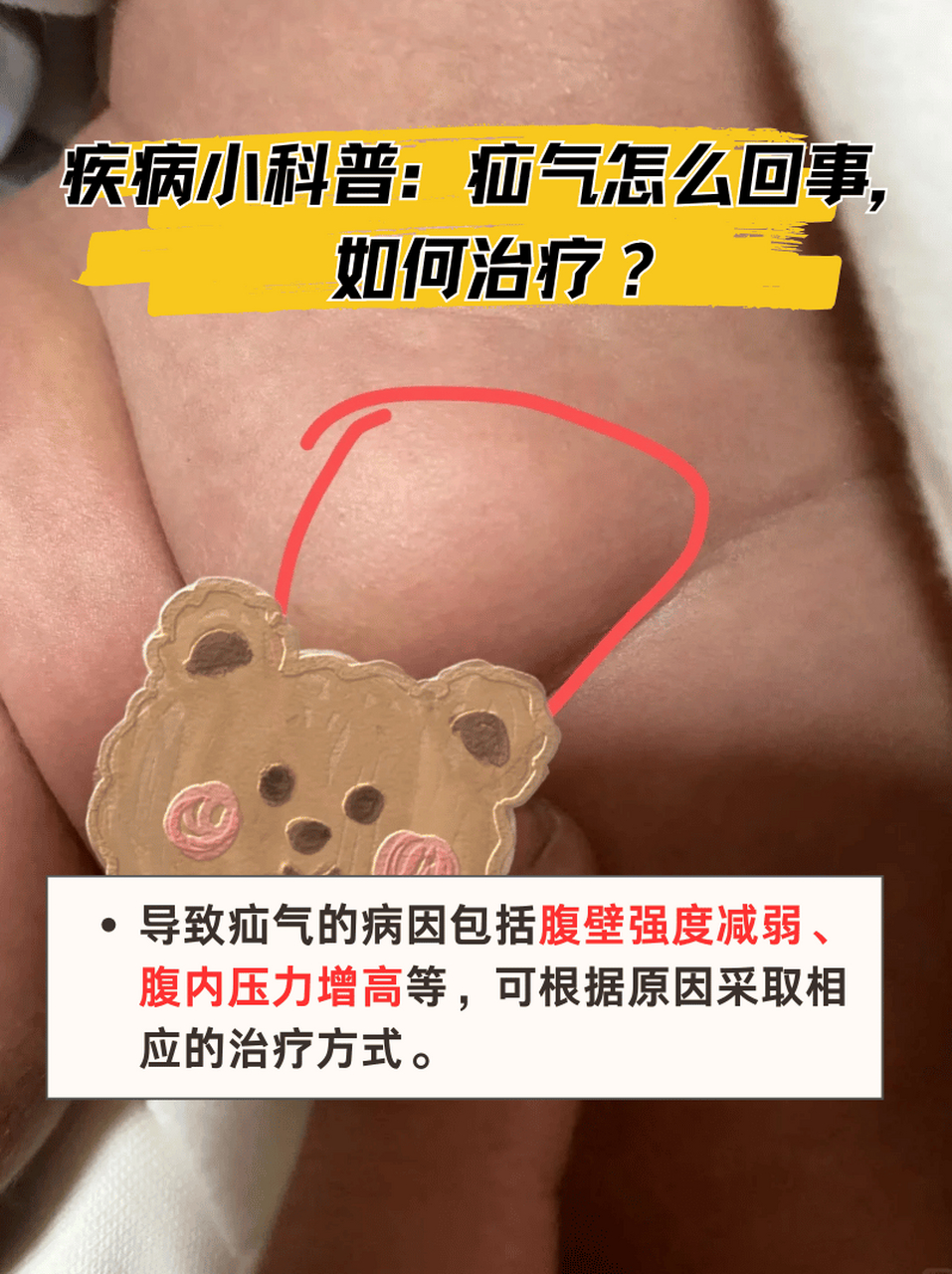 疾病小科普:疝气怎么回事,如何治疗?
