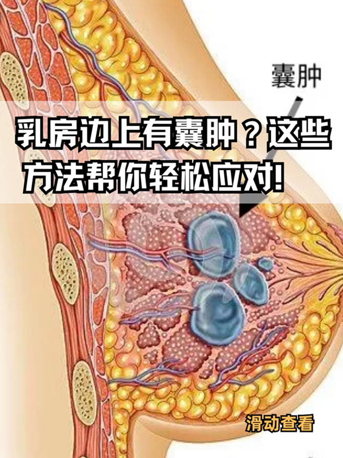 这些方法帮你轻松应对!  发现乳房边上有囊肿?