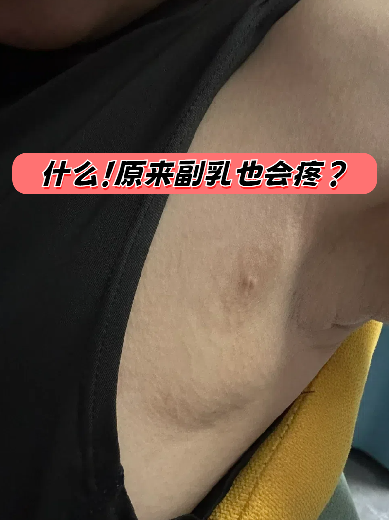 副乳图片长在什么位置图片