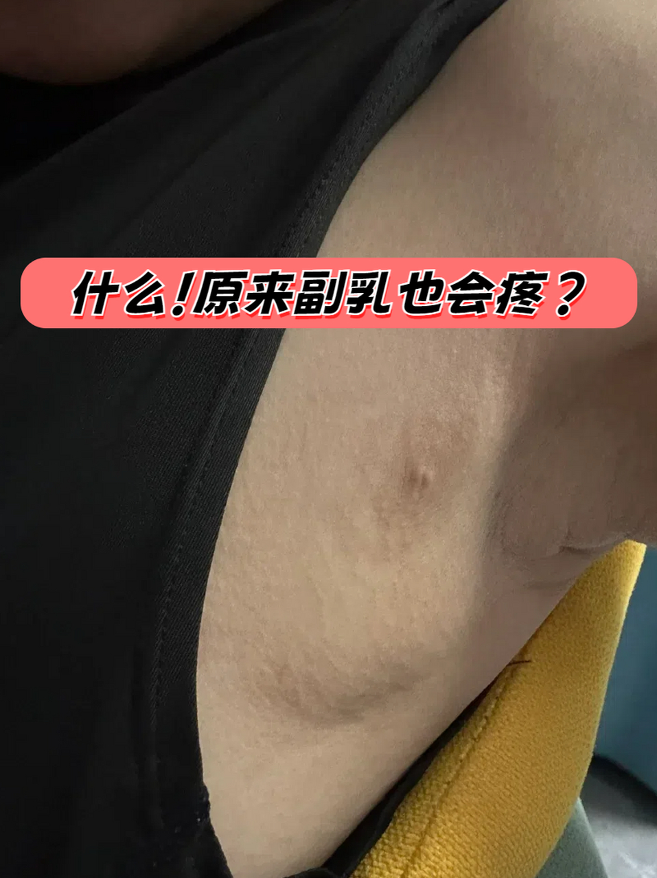 原来副乳也会疼?  副乳通常是在腋下或胸部边缘处的脂肪组织