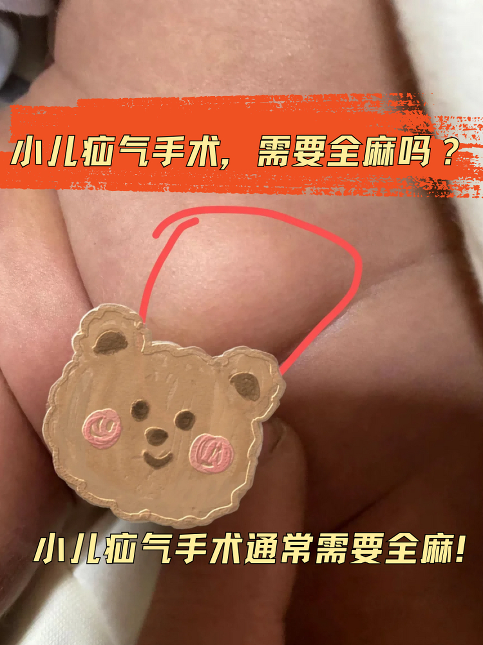 🙋小儿疝气手术通常需要全麻!