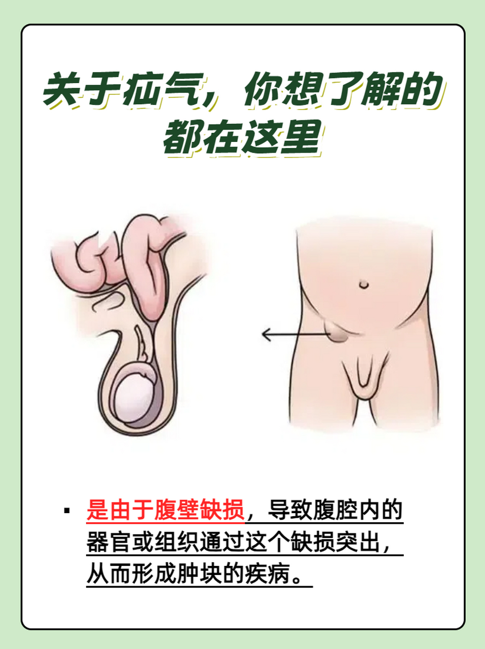 腹股沟疝位置图图片