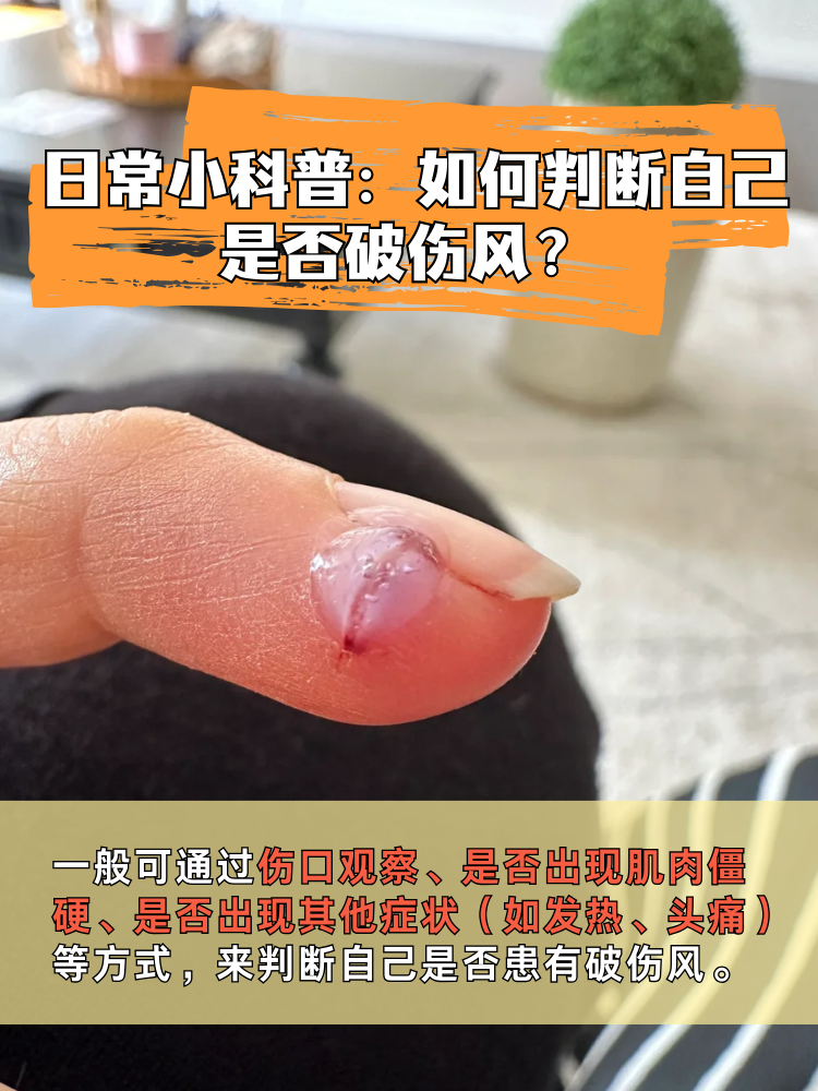 一小点伤口会得破伤风吗 				 一小点伤口也可能得破伤风