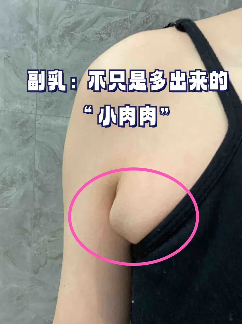 腋下副乳图图片