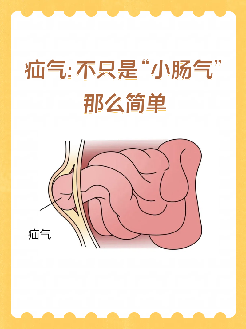 腹壁间层疝图片