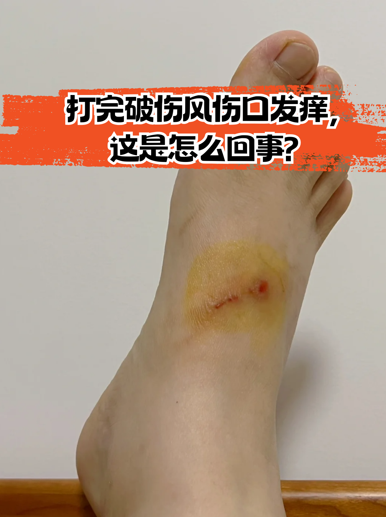 打完破伤风伤口发痒,这是怎么回事?