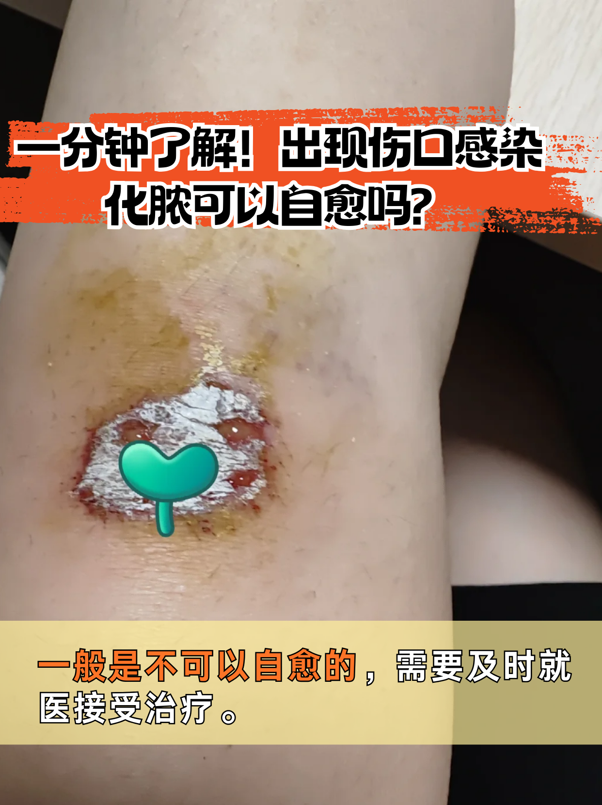 出现伤口感染化脓可以自愈吗?
