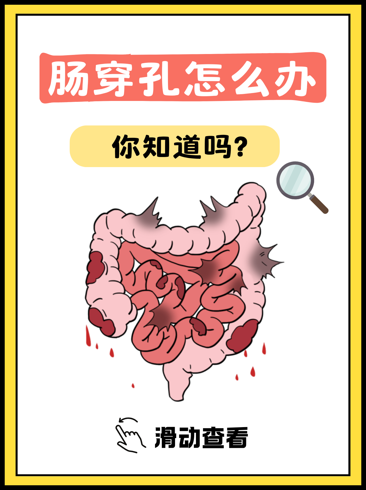 大家可能都听说过肠穿孔,但你真的了解它吗?