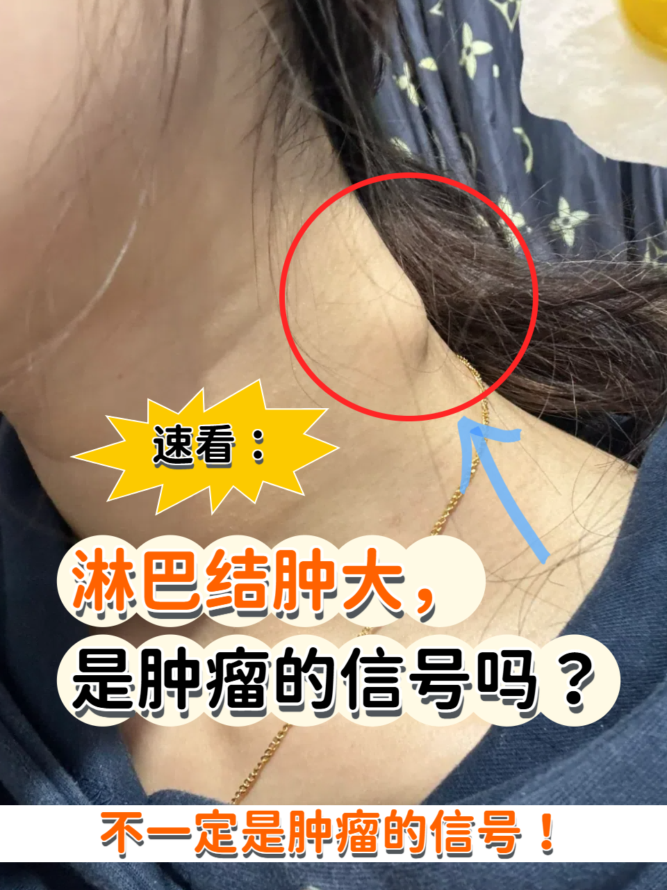 首先回答,淋巴结肿大不一定是肿瘤的信号! 淋巴