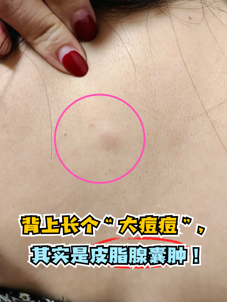 可能是皮脂腺囊肿惹的祸哦!今天让我们一起去详细了解下!