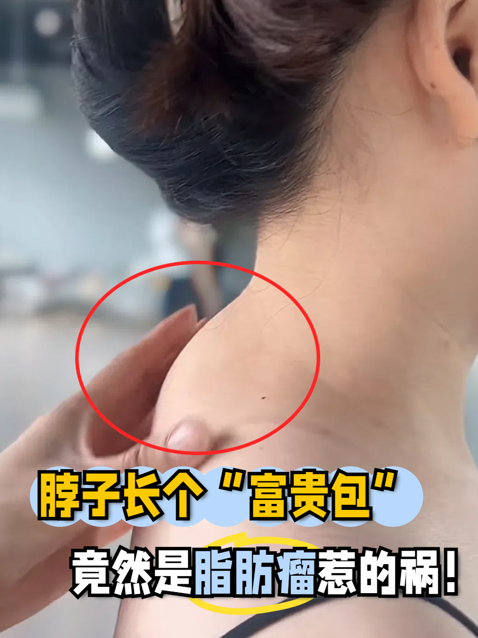 人身上为什么长脂肪瘤