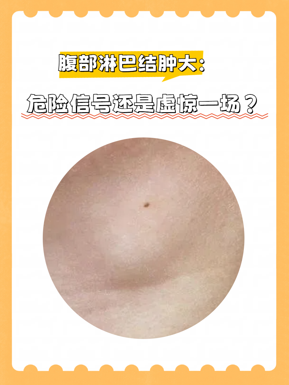 腹部淋巴结肿大是否