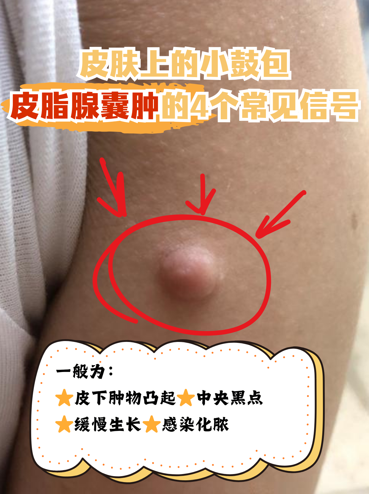 皮肤上的小鼓包:皮脂腺囊肿的4个常见信号