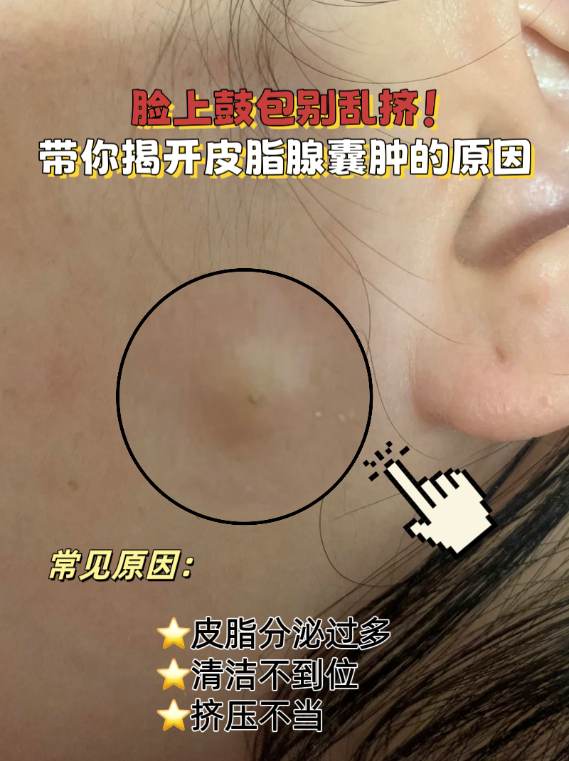带你揭开皮脂腺囊肿的原因