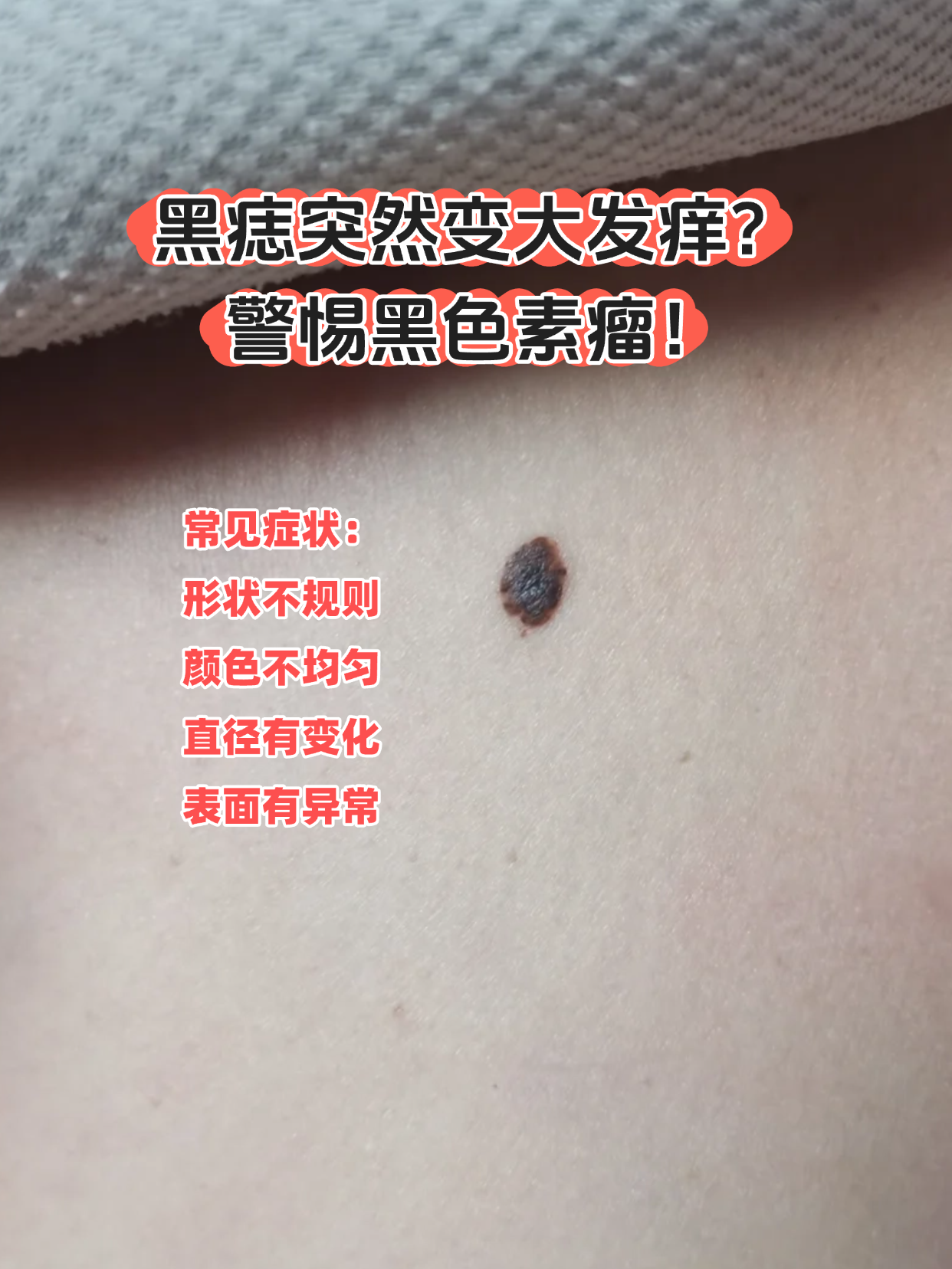 当黑痣形状怪异,颜色不均,甚至出现破溃出血时,很可能是黑色素瘤的