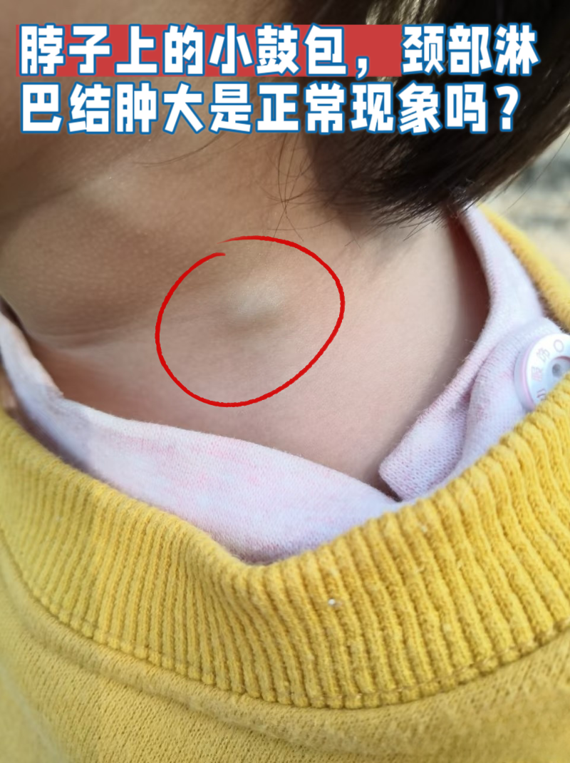 一文带你读懂淋巴结肿大背后的秘密