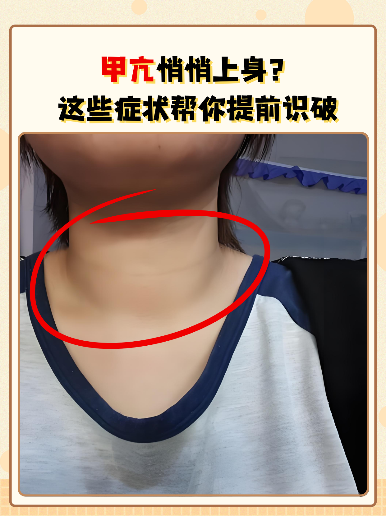 别以为是"新陈代谢好",可能是甲状腺功能亢进症