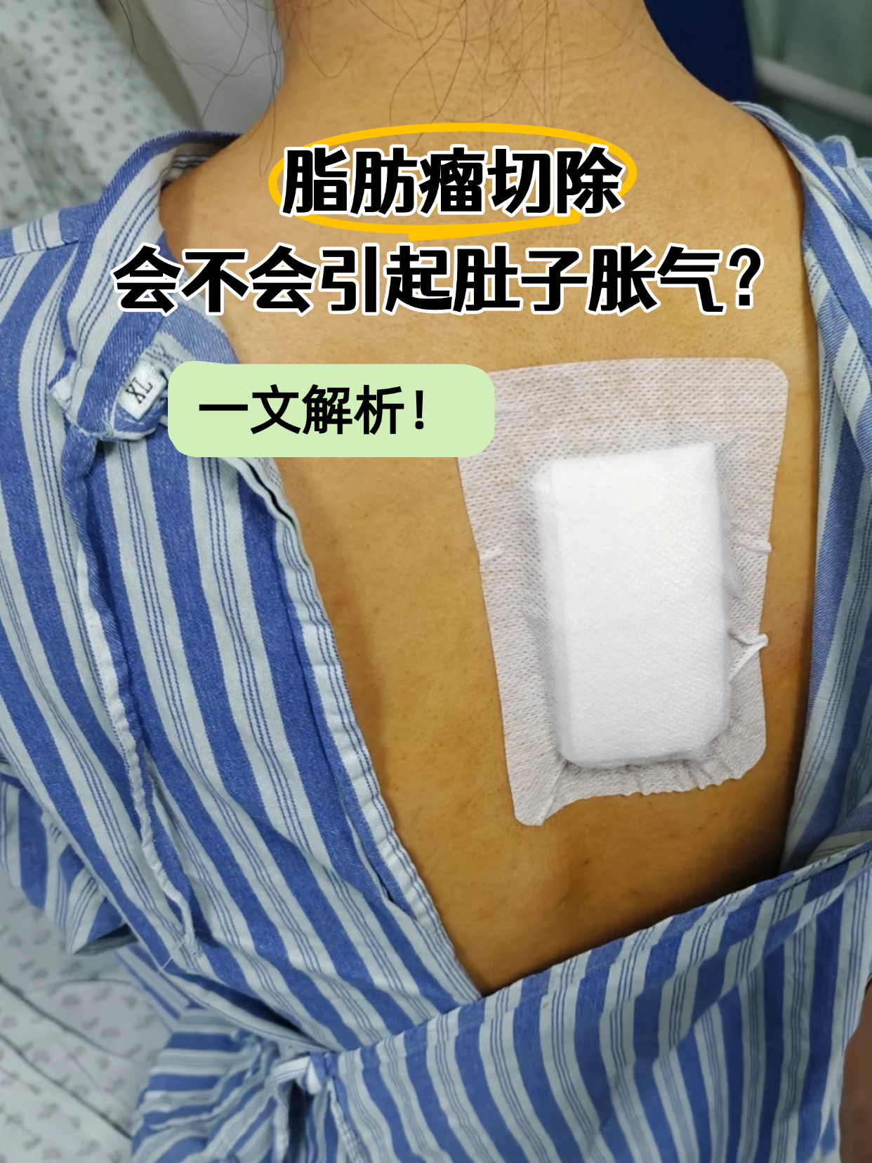 为什么不建议切除脂肪瘤?为什么在线