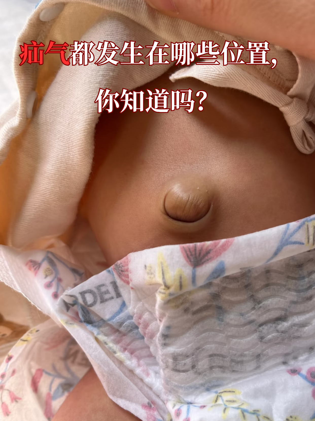 发现腹部,大腿根突然鼓起小包,一按还能缩回去?这可能是疝气找上门!