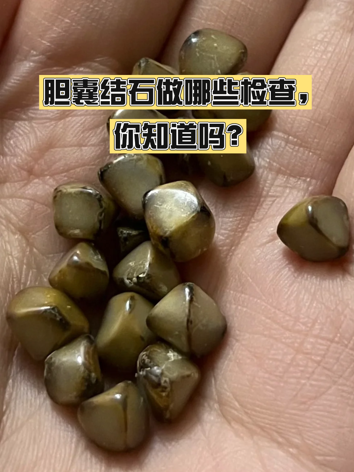 右上腹隐隐作痛,吃油腻食物就恶心,怀疑胆囊结石却不知该做什么检查
