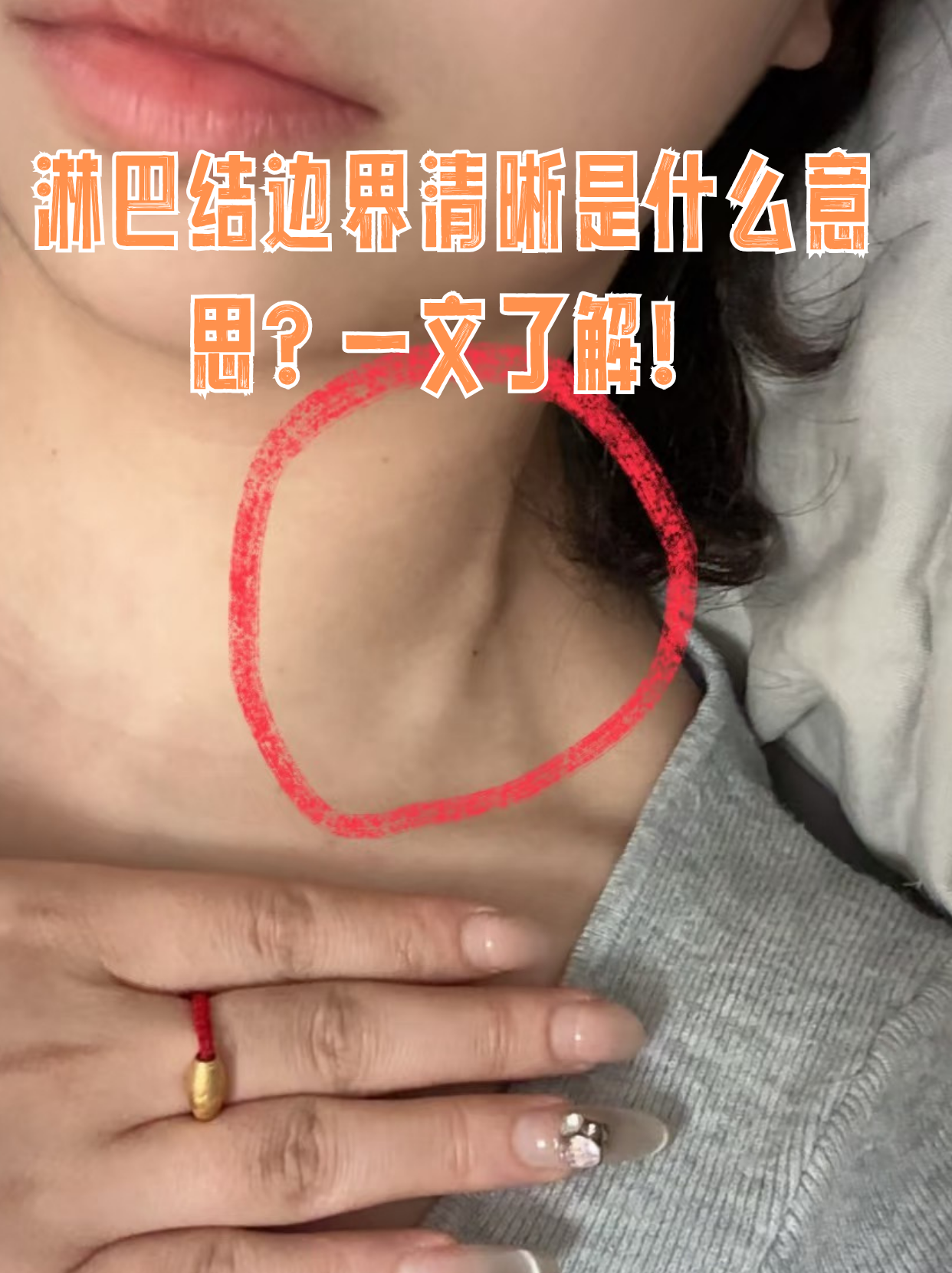 淋巴结边界清晰的含义 形态特征:边界清晰指锁骨淋巴结位置图片淋巴