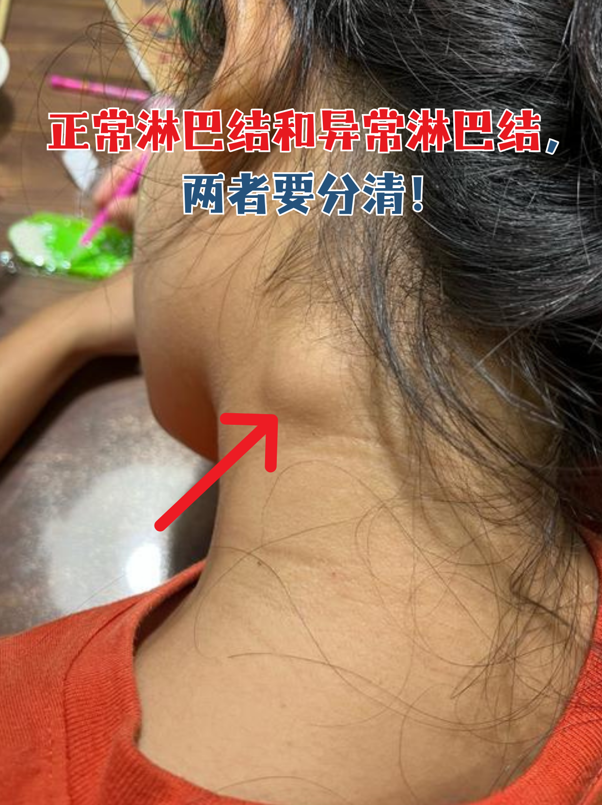 淋巴结是身体的"健康哨兵",摸到脖子或腋下有肿块先别慌