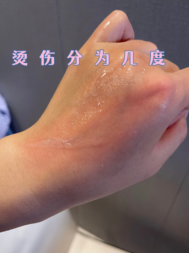 烫伤是生活中常见的外伤,根据皮肤损伤深度可分为三度