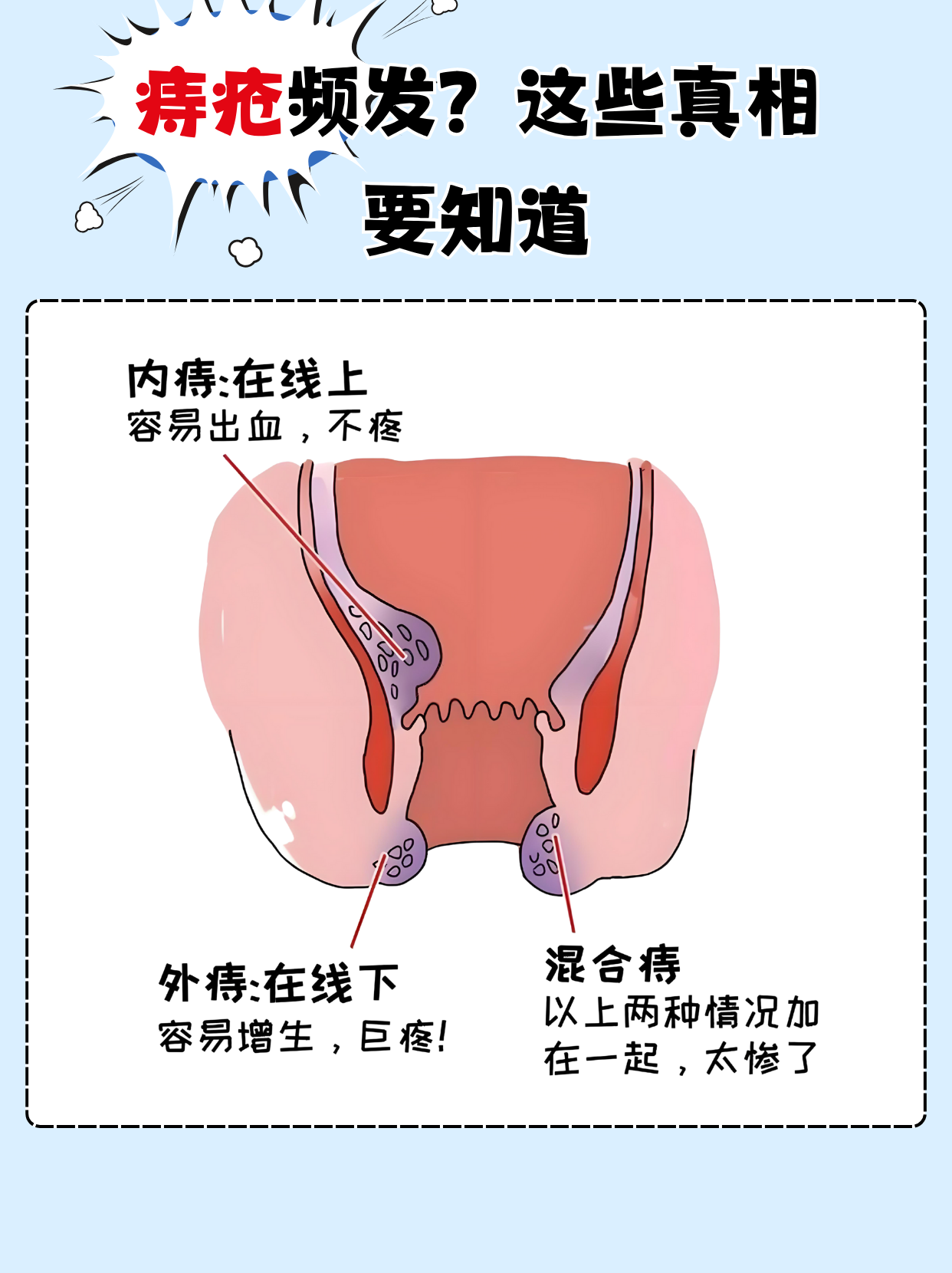 夏天一到,痔疮发作的人明显增多,久坐,辛辣饮食,如厕