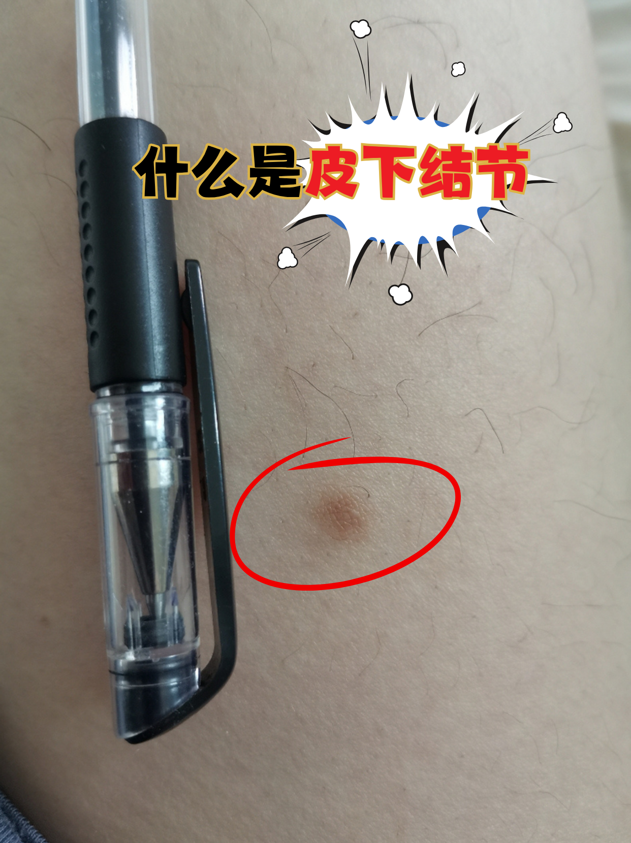 皮下结节是藏在皮肤下的小硬块,摸起来像绿豆或黄豆