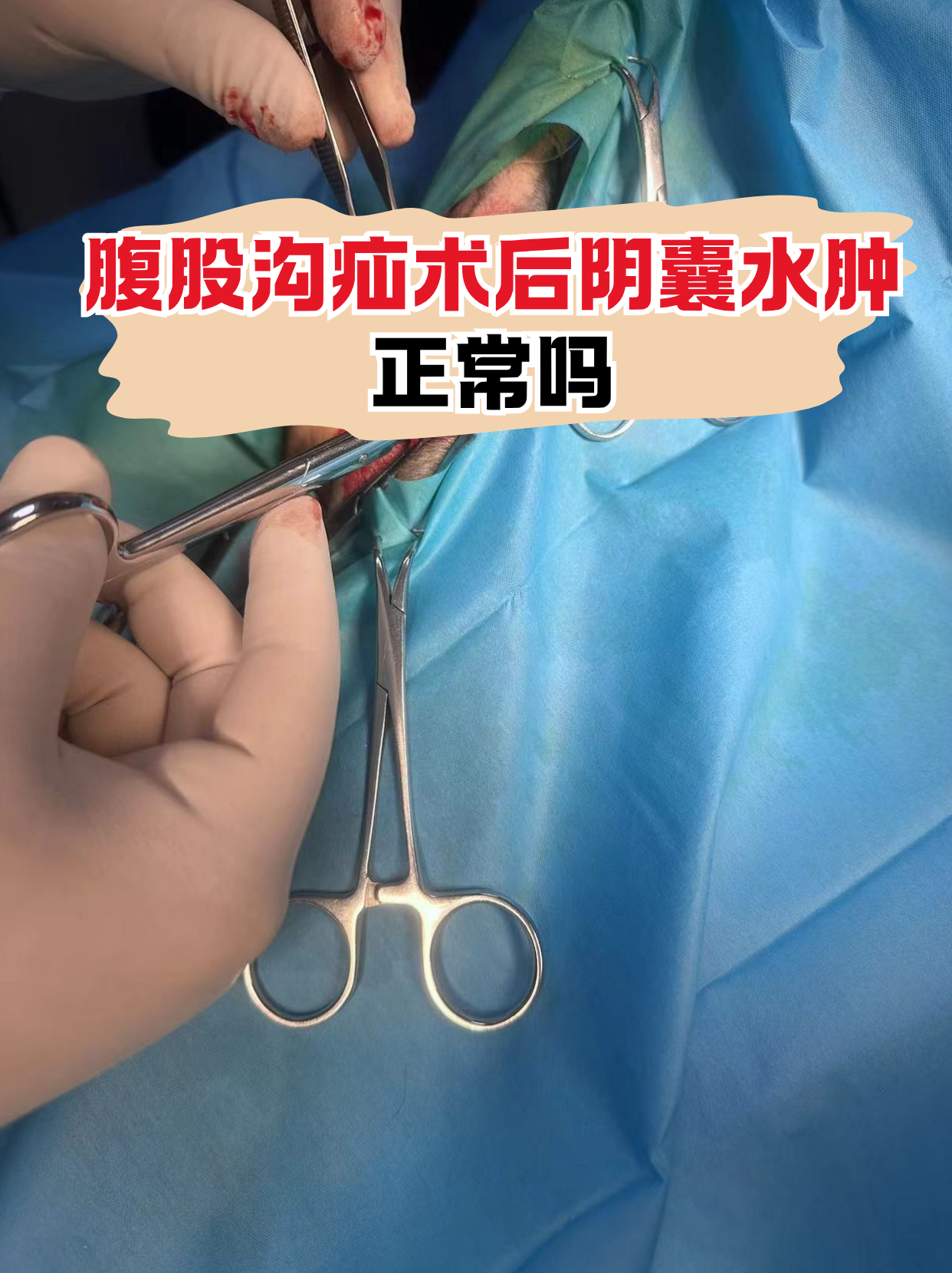 腹股沟疝手术后阴囊出现轻微水肿其实很常见,这与术中淋巴管暂时受损